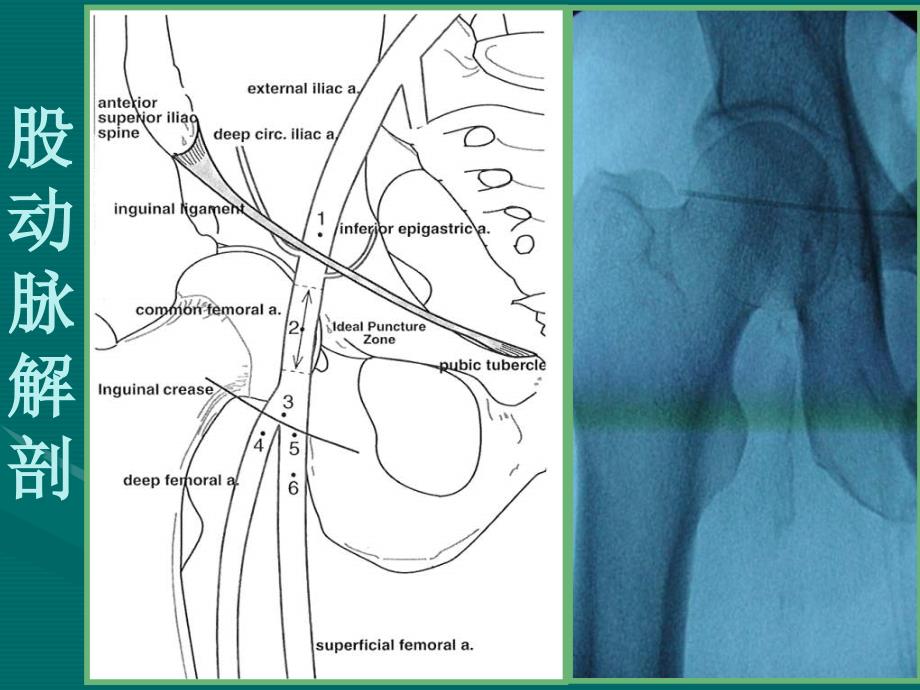 最新下肢动脉穿刺PPT文档_第3页