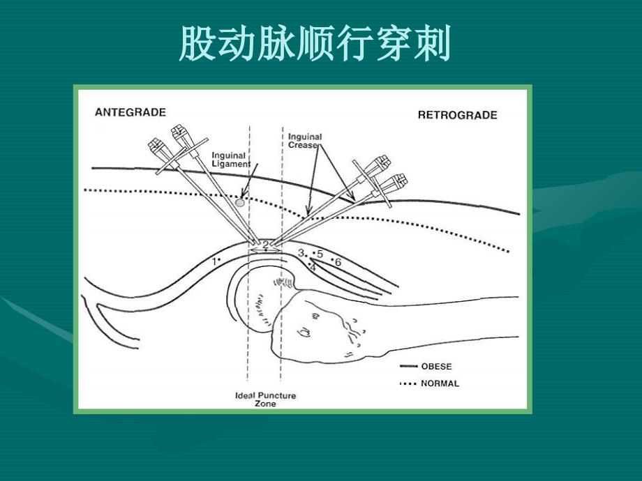 最新下肢动脉穿刺PPT文档_第4页