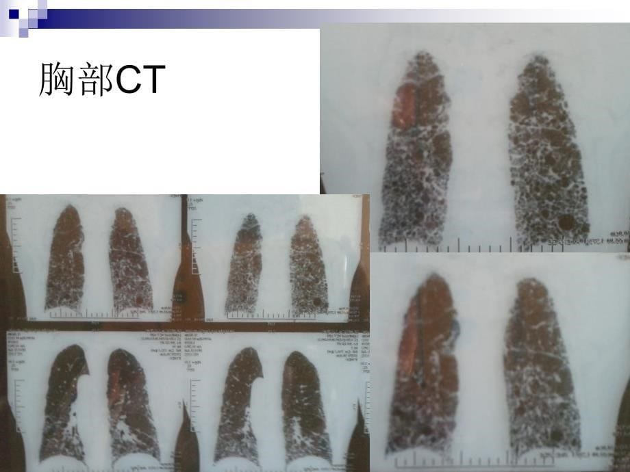 纤维化护理查房_第5页