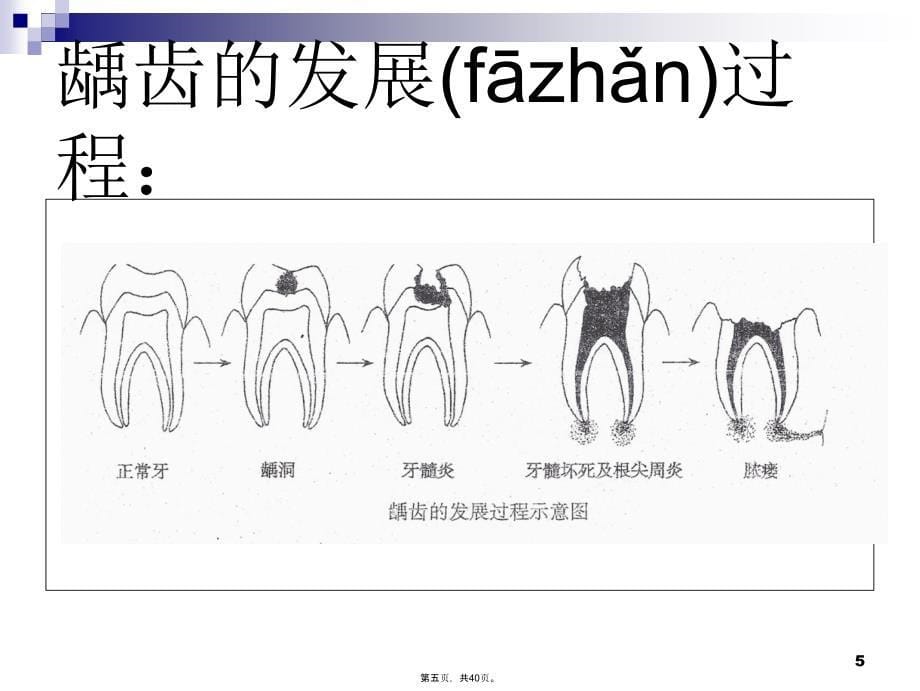 中小学生健康教育龋齿防治说课讲解_第5页