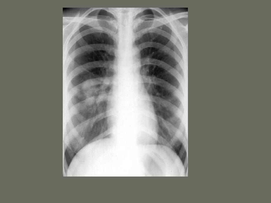 医学ppt肺部疾病的x诊断文档资料_第4页