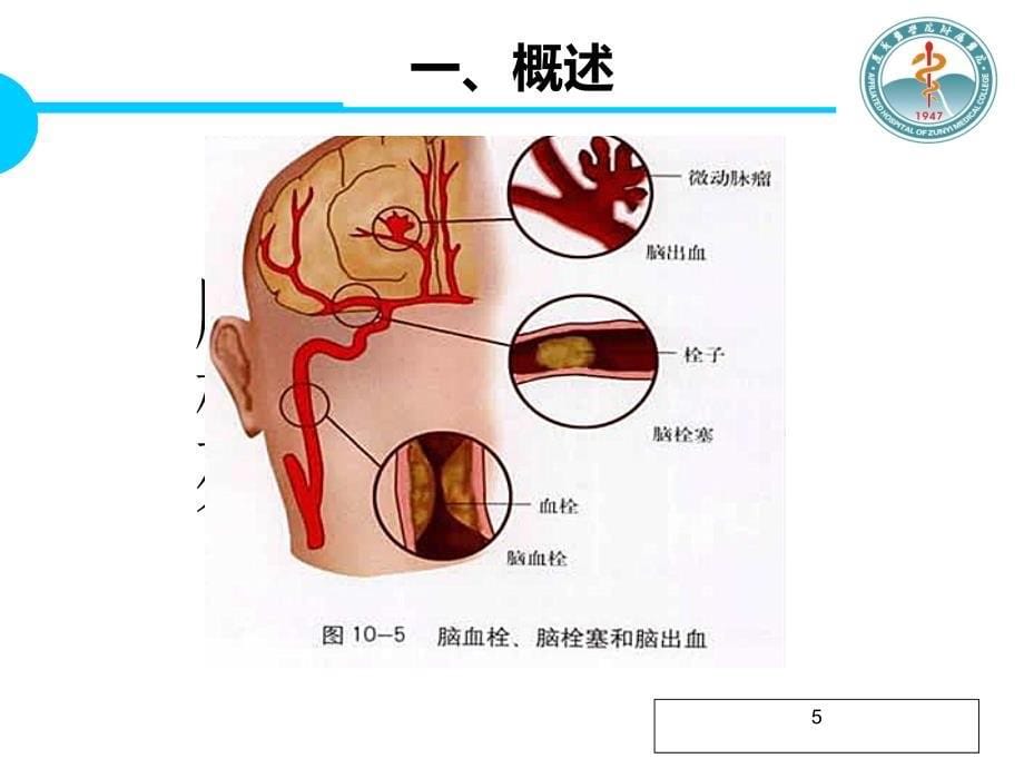 脑梗死患者的护理PPT通用课件_第5页