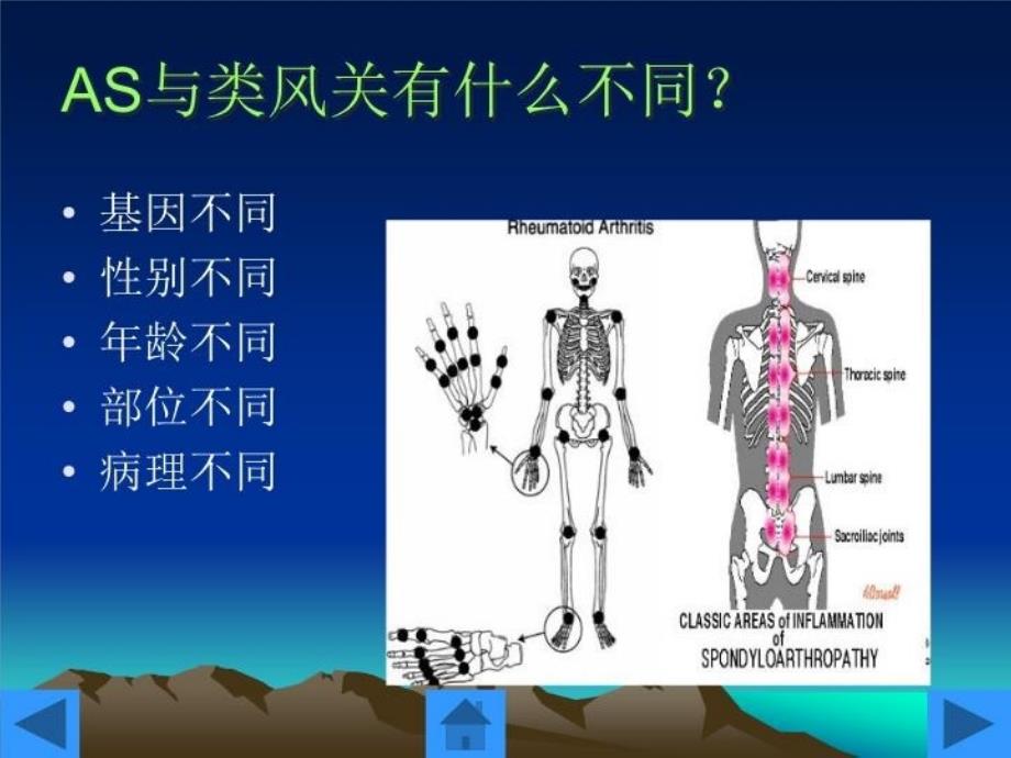 最新强直性脊柱炎的护理PPT课件_第4页