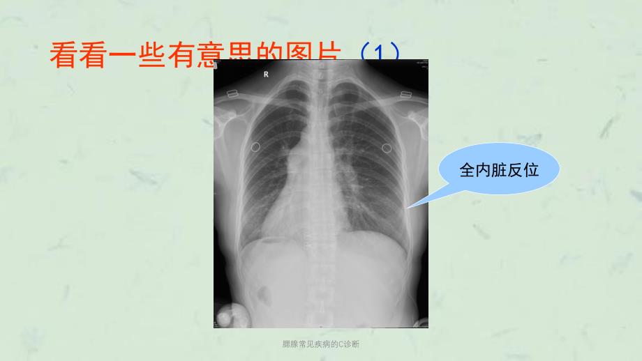 腮腺常见疾病的C诊断课件_第2页