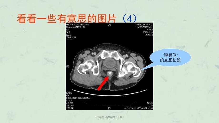 腮腺常见疾病的C诊断课件_第5页