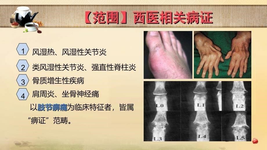 中医内科学-痹证课件_第5页