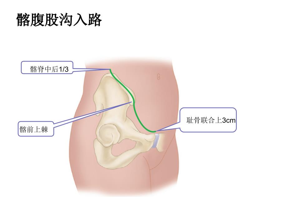 髋关节置换手术切口_第1页