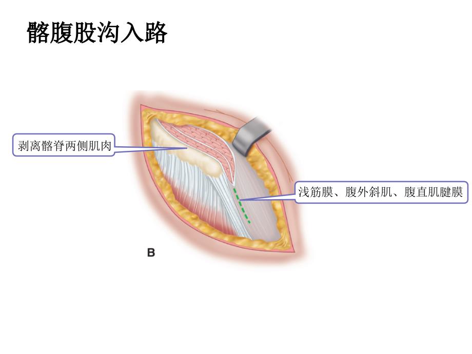 髋关节置换手术切口_第2页