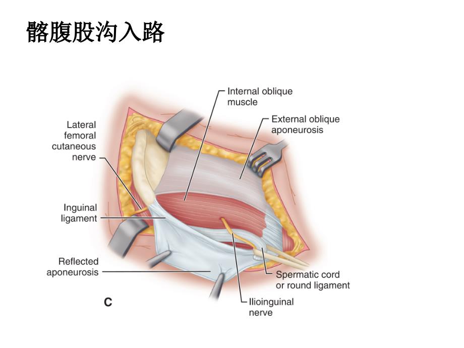 髋关节置换手术切口_第3页