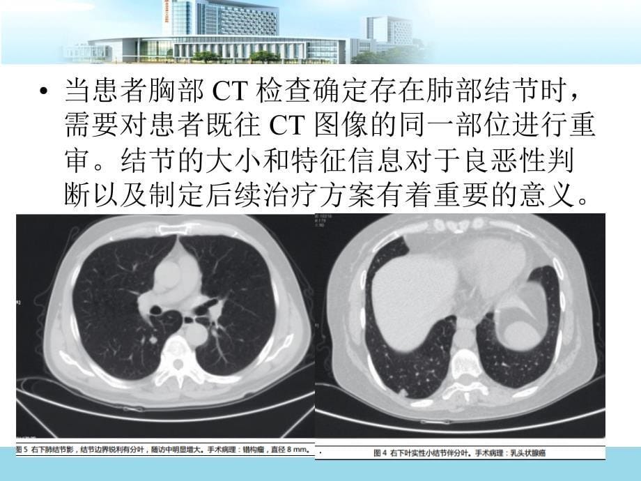 肺结节诊治指南课件_第5页