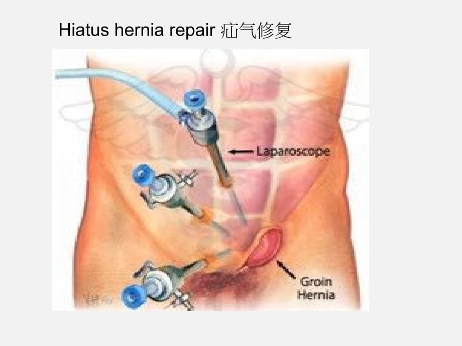 心肺功能不全的物理治疗诊断与治疗：general surgery_第5页