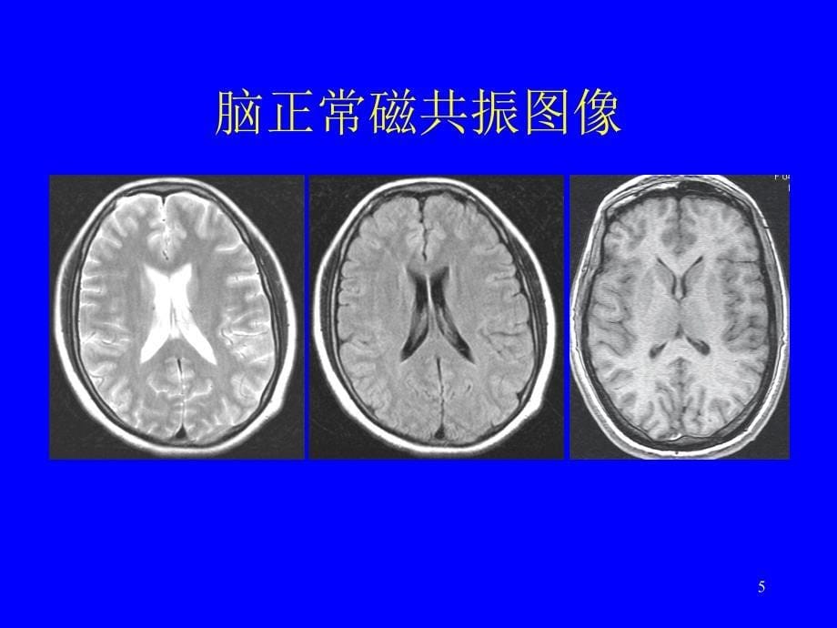 脑肿瘤的磁共振诊断课件_第5页