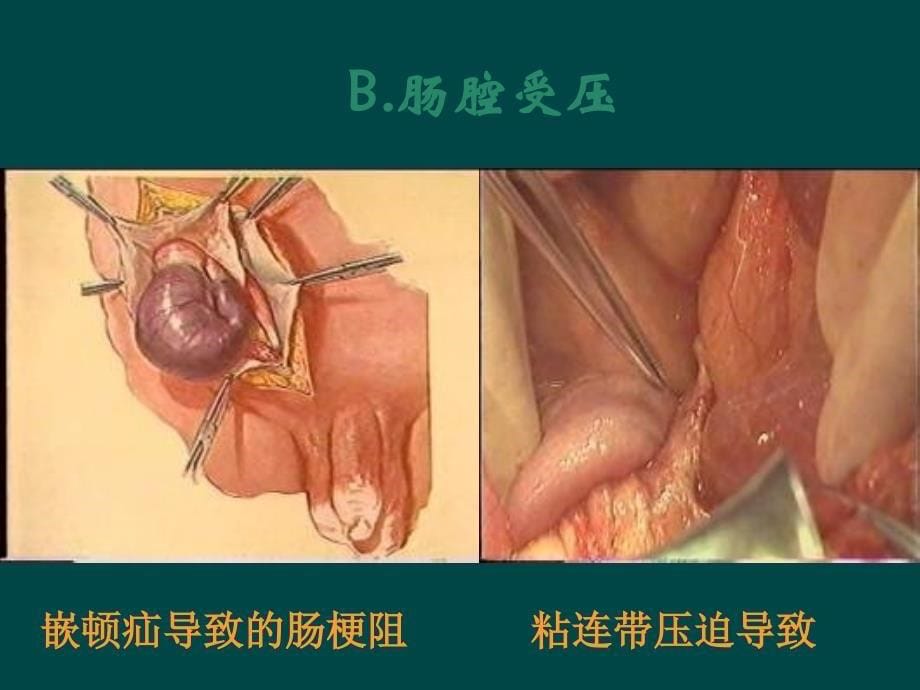 --肠梗阻PPT课件_第5页