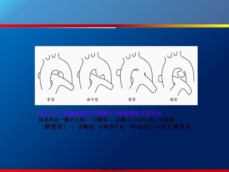 医学专题—动脉导管未闭、主动脉狭窄6576_第4页