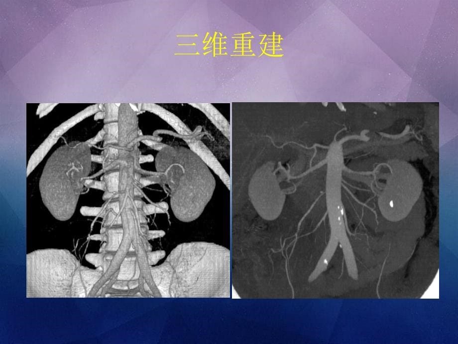 多排螺旋CT心血管成像_第5页