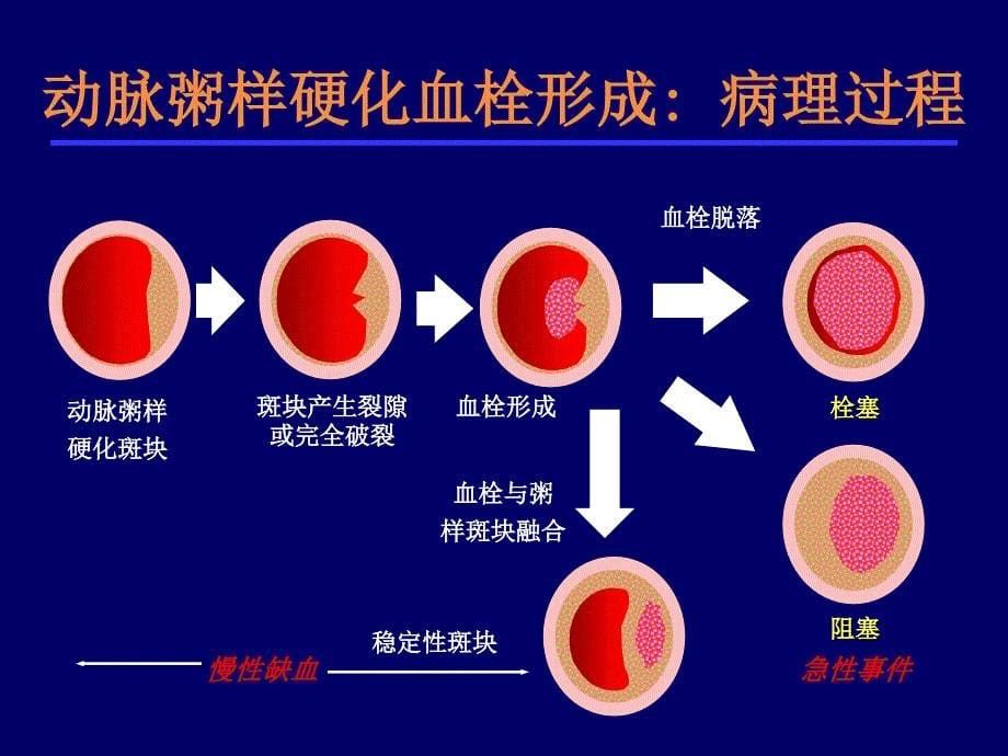 急性脑梗死的溶栓及抗栓治疗_第5页