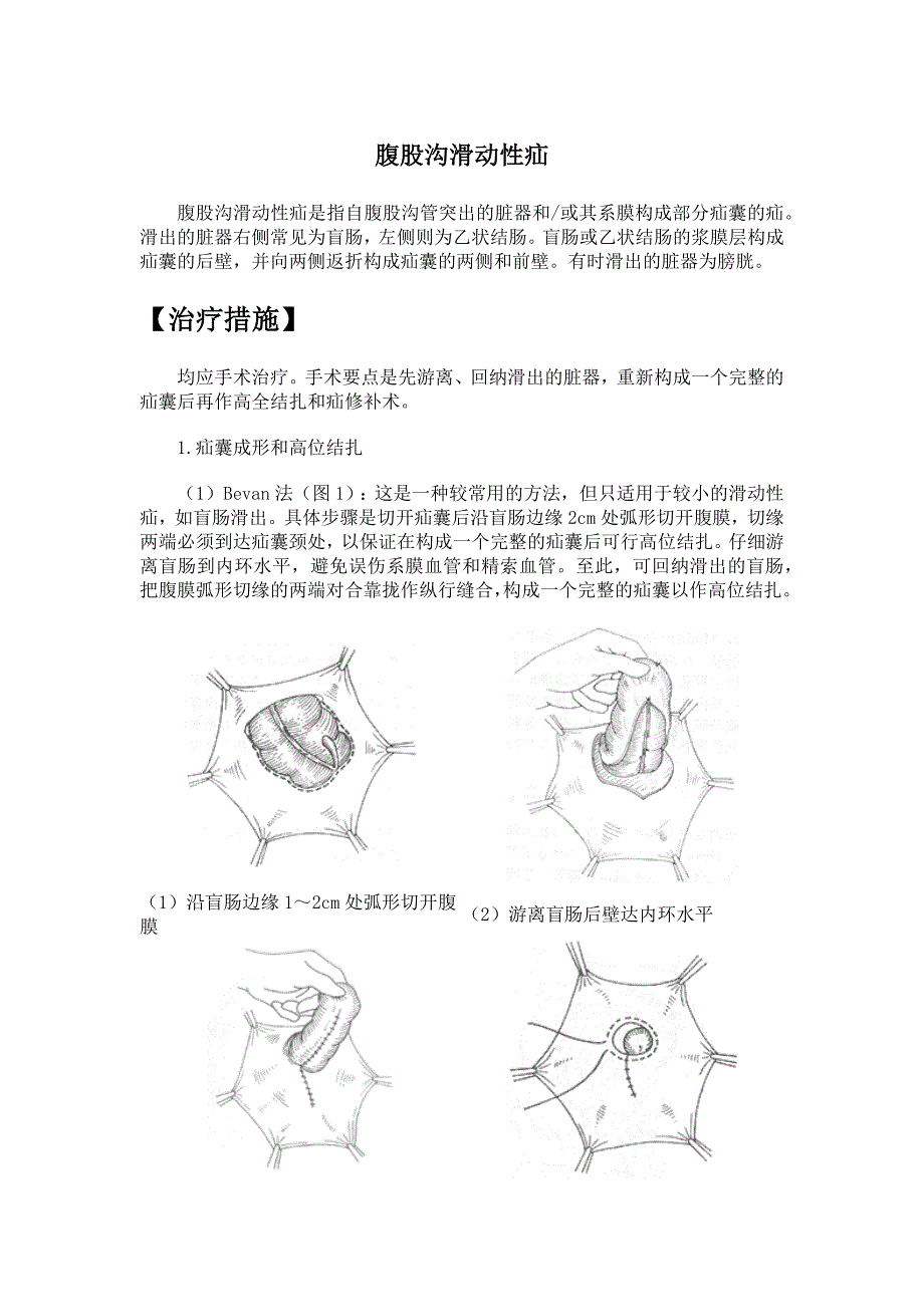 腹股沟滑动性疝.docx_第1页