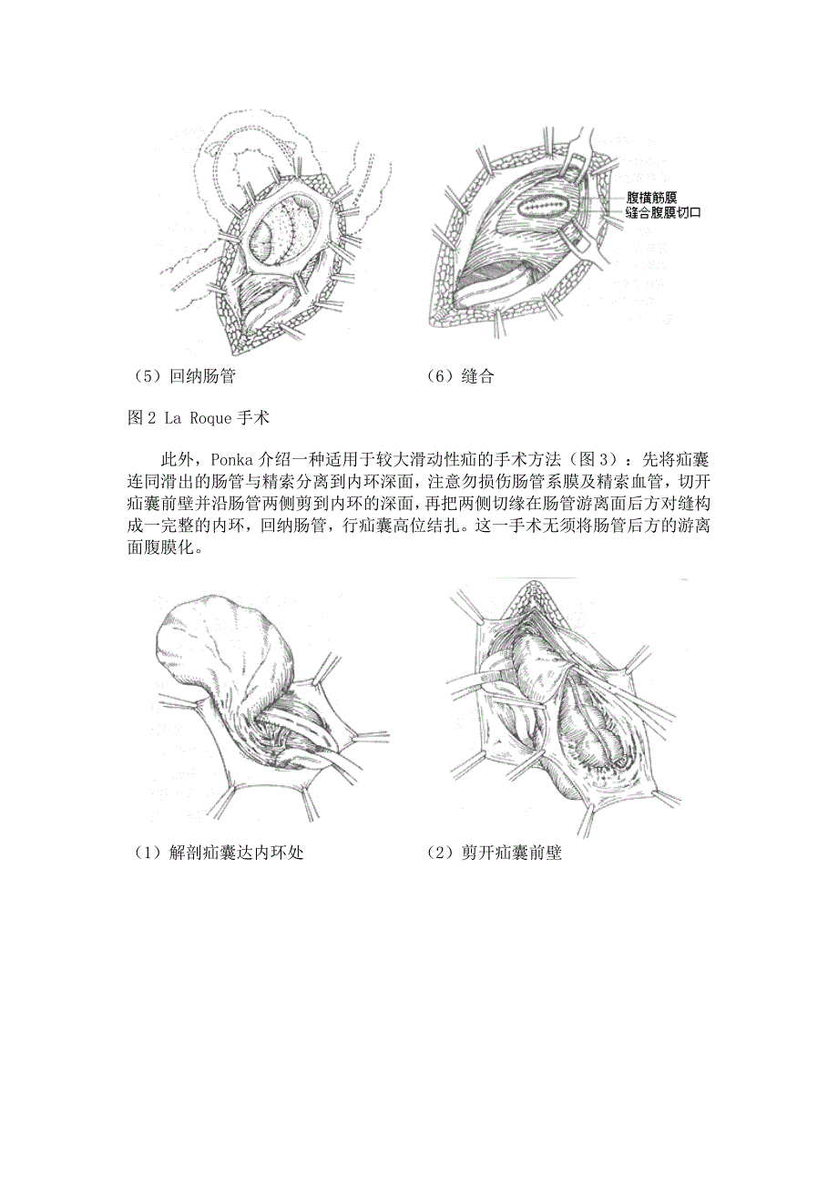 腹股沟滑动性疝.docx_第3页