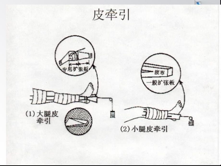 牵引术后的护理要点课件.ppt_第5页