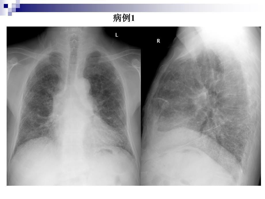 影像诊断学讨论课件：不明原因肺疾病及肺血液循环障碍性疾病_第5页