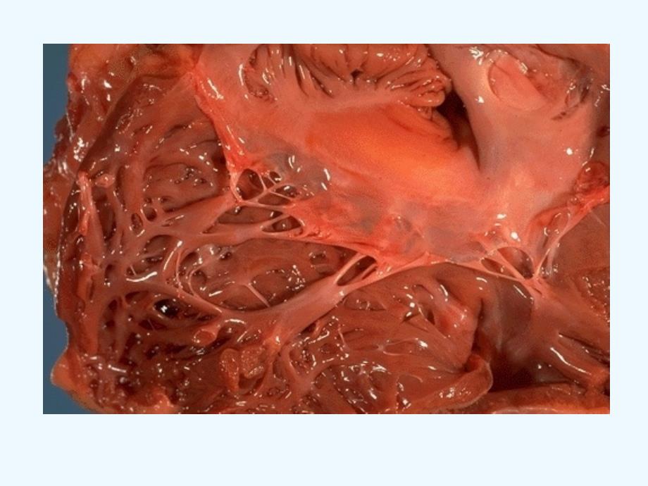 病理解剖大体标本课件：六、心血管系统疾病_第4页