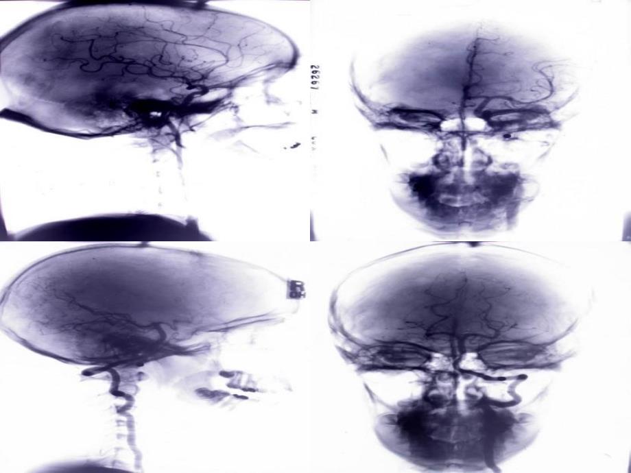 《自编脑血管造影》PPT课件_第2页