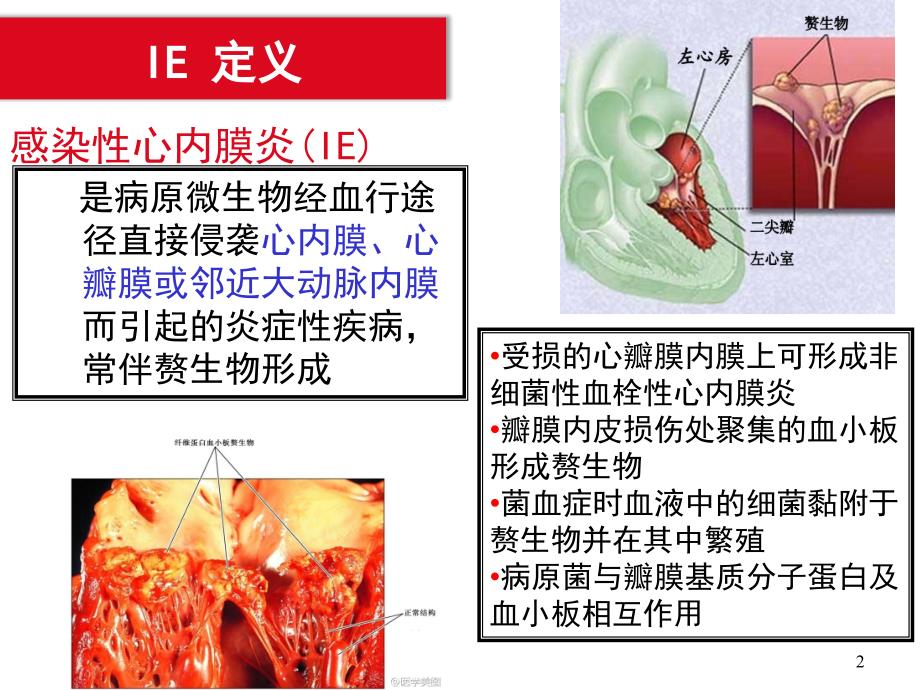 感染性心内膜炎指南ppt课件_第2页