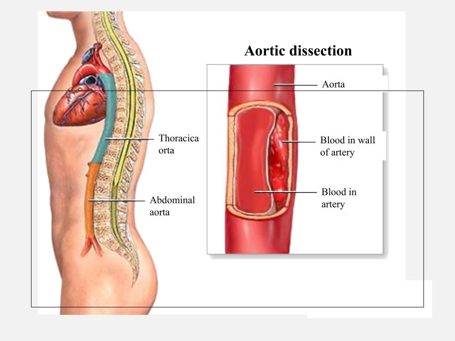 主动脉夹层PPT_第4页