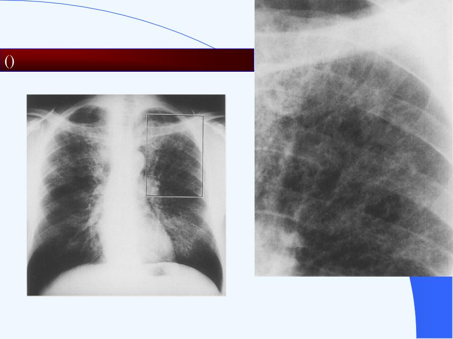 艾滋病临床影像诊断(胸)课件_第4页
