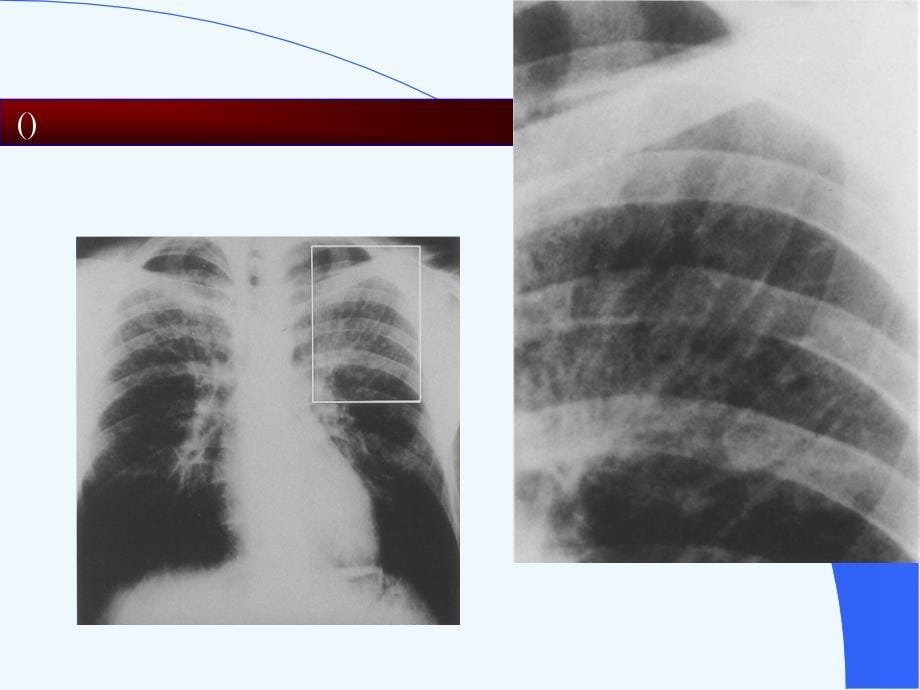艾滋病临床影像诊断(胸)课件_第5页