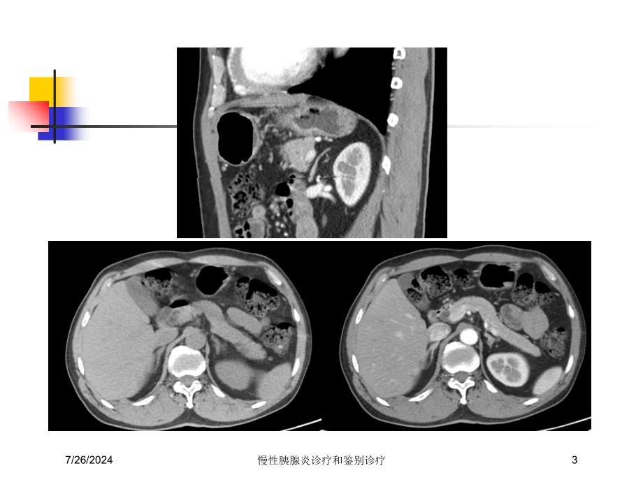 慢性胰腺炎诊疗和鉴别诊疗培训课件_第3页