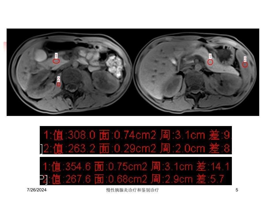 慢性胰腺炎诊疗和鉴别诊疗培训课件_第5页