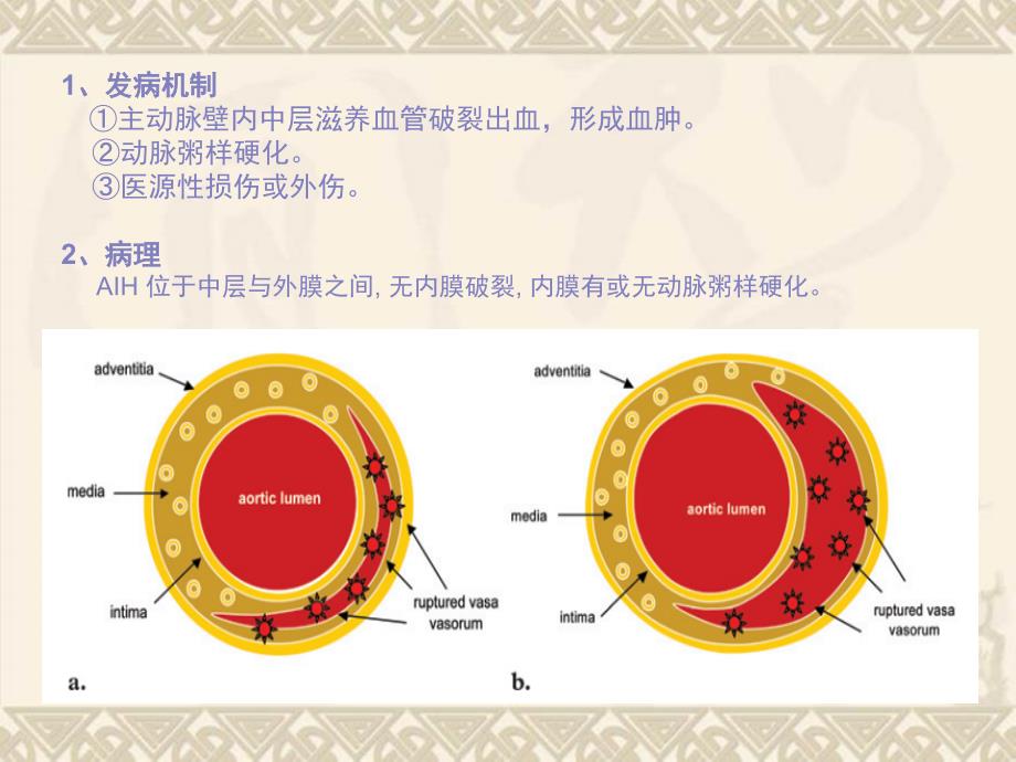 壁内血肿演变及CT表现_第3页