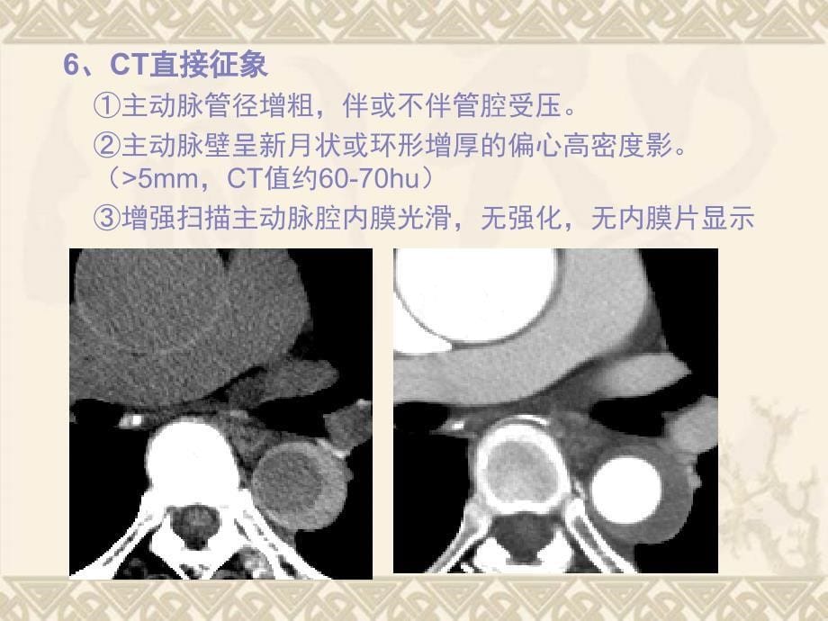 壁内血肿演变及CT表现_第5页