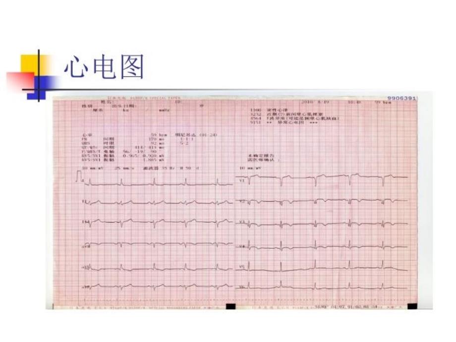 最新双侧桡动脉路径逆向PCI1例PPT课件_第4页