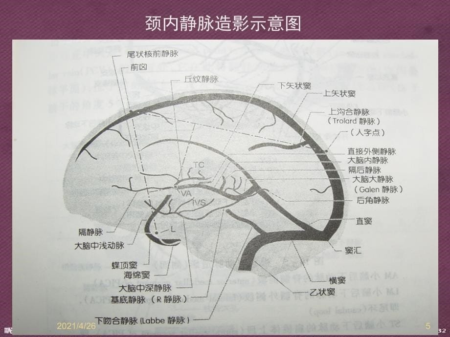 静脉窦血栓MR诊断教学课件_第5页