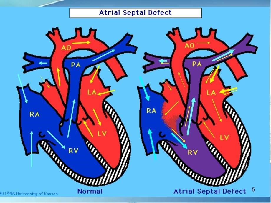 儿童先天性心脏病_第5页