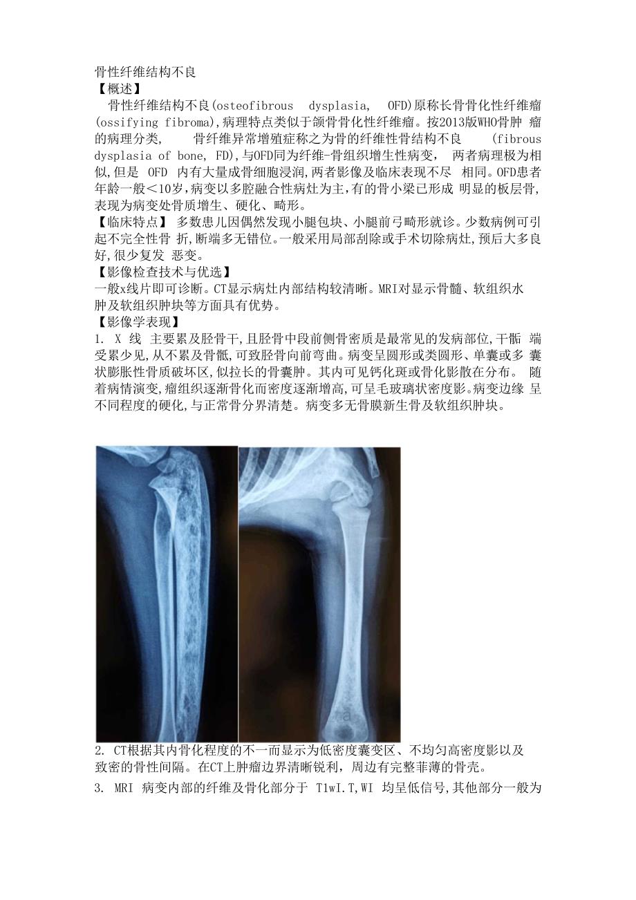 骨纤维结构不良_第1页