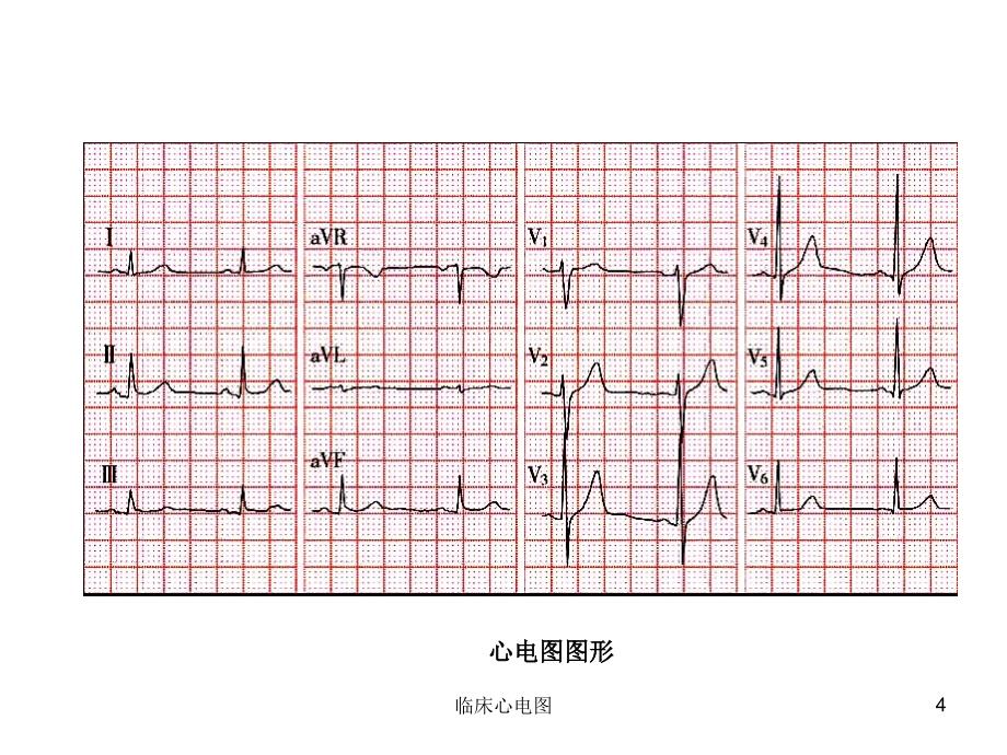 临床心电图课件_第4页