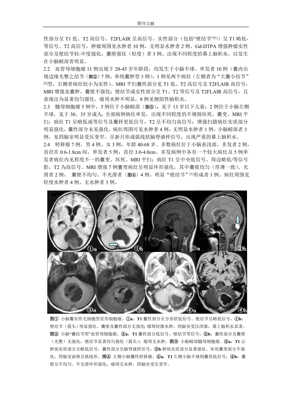 小脑囊性肿瘤的MRI 影像学分析.doc_第2页