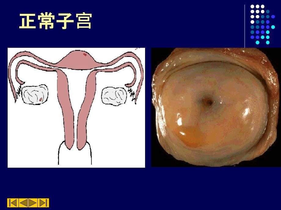 病理生殖系统疾病 ppt课件_第5页