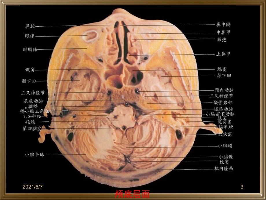 中枢神经系统断层影像PPT课件_第3页