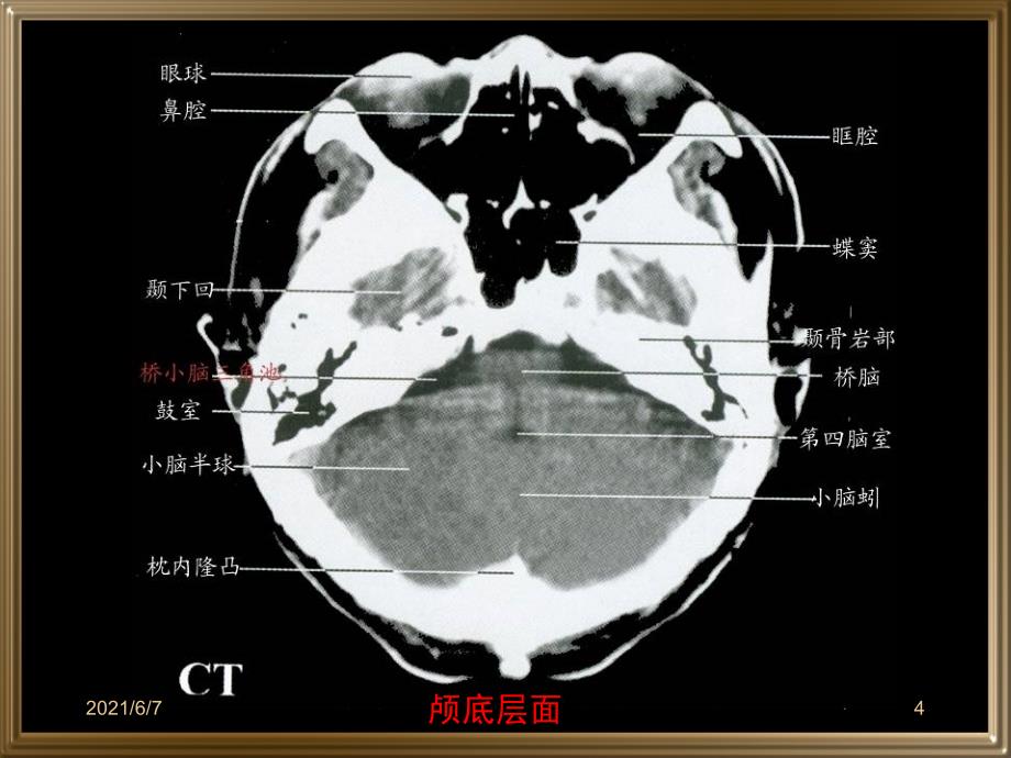 中枢神经系统断层影像PPT课件_第4页