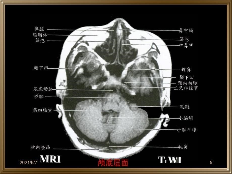 中枢神经系统断层影像PPT课件_第5页