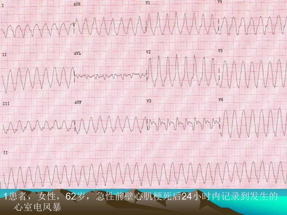 心室电风暴的特征与救治课件_第4页
