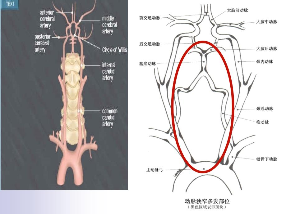 眩晕与后循环缺血分析课件_第3页