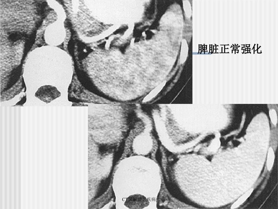 CT脾脏及其疾病培训课件_第5页