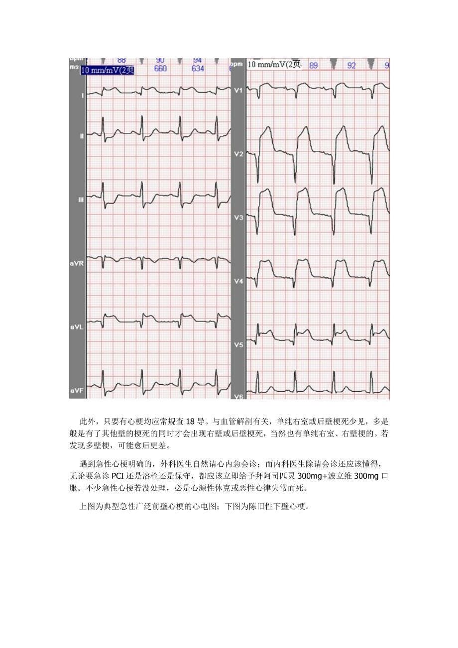 [转] 看了它就能看懂心电图室大部分心电图_第5页