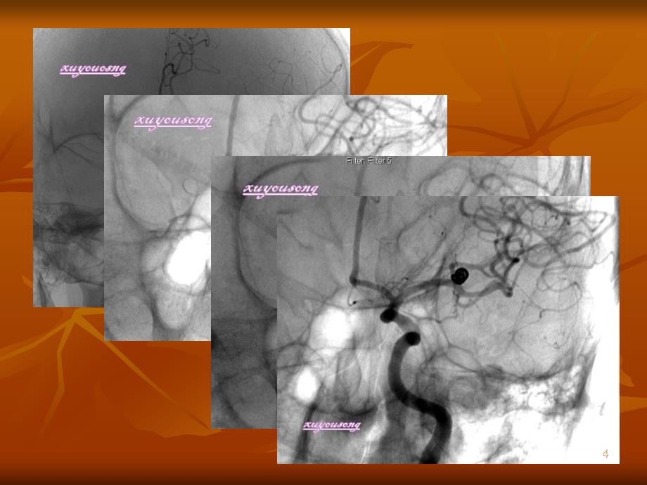 大脑中动脉动脉瘤的个性化治疗课件_第4页