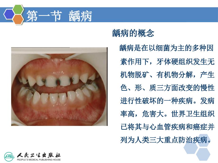 牙体牙周组织疾病课件_第3页